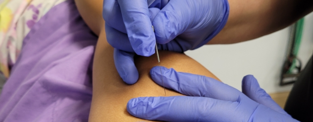 Dry Needling Amber Hill Physical Therapy