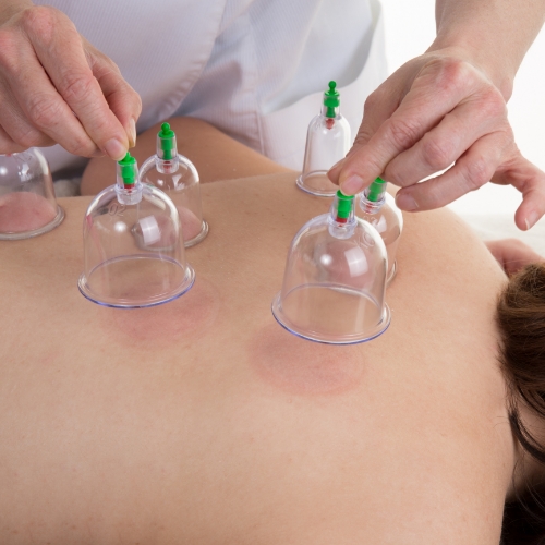Cupping-therapy-Amber-Hill-Therapy-Centers-Maryland