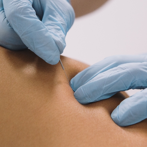 Dry-needling-Amber-Hill-Therapy-Centers-Maryland