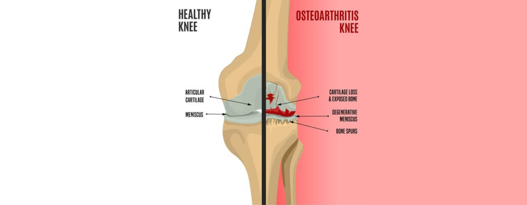 Physical_Therapy_for_Knee_Osteoarthritis